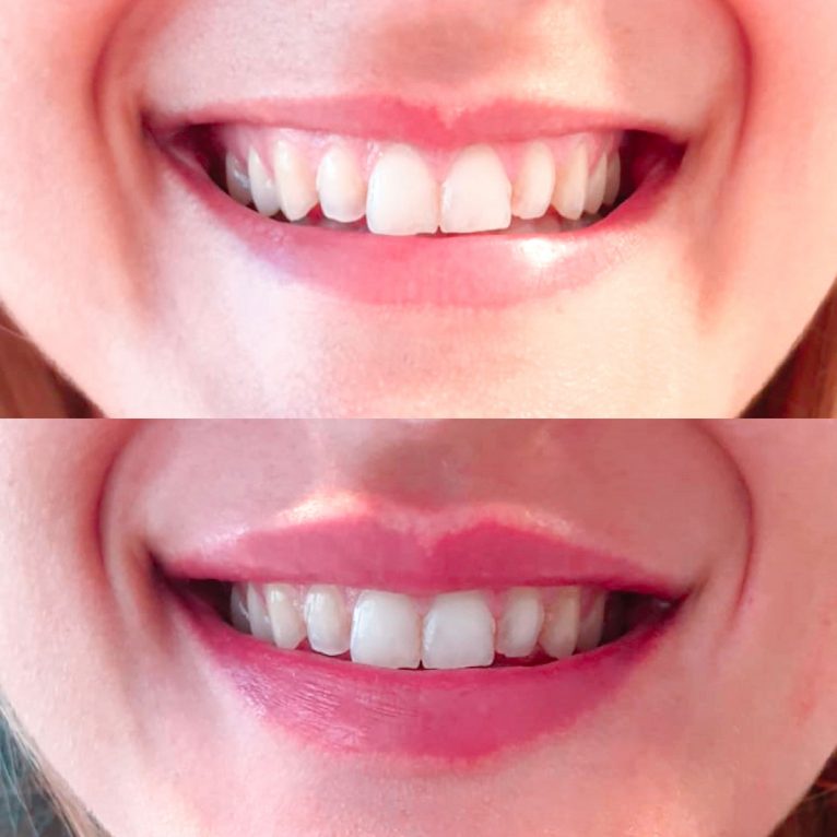 Antes y después de una sonrisa gingival - Clínica Estética Castelblanque