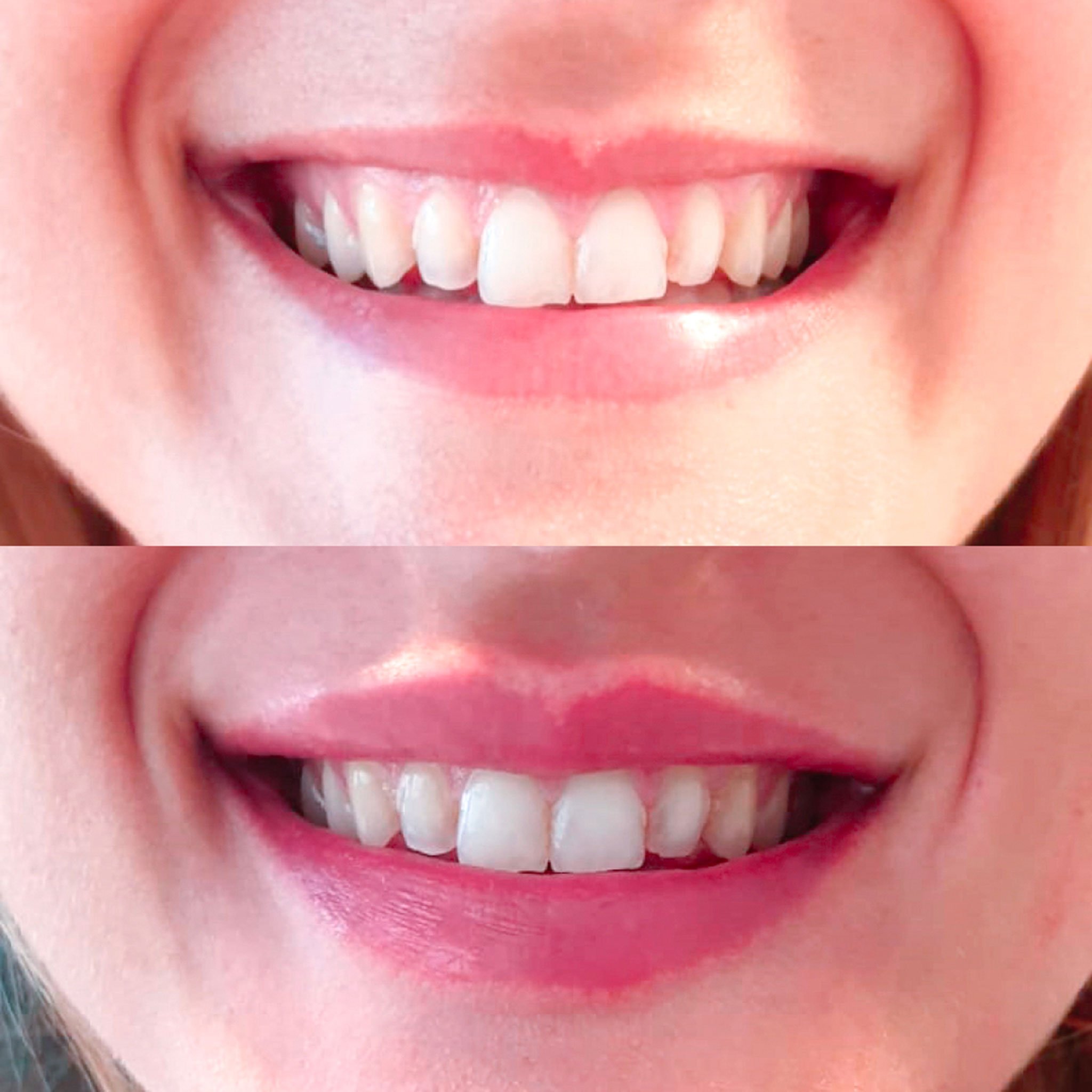 Antes y después de una sonrisa gingival – Clínica Estética Castelblanque