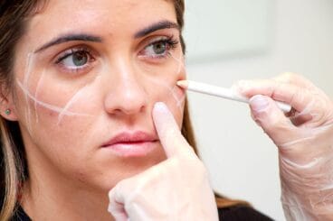 caso-exito-tratamiento-con-acido-hialuronico-para-proyectar-pomulos-clinica-estetica-castelblanque
