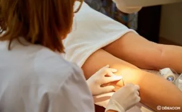 Esclerosis de varices – Policlínica CUME