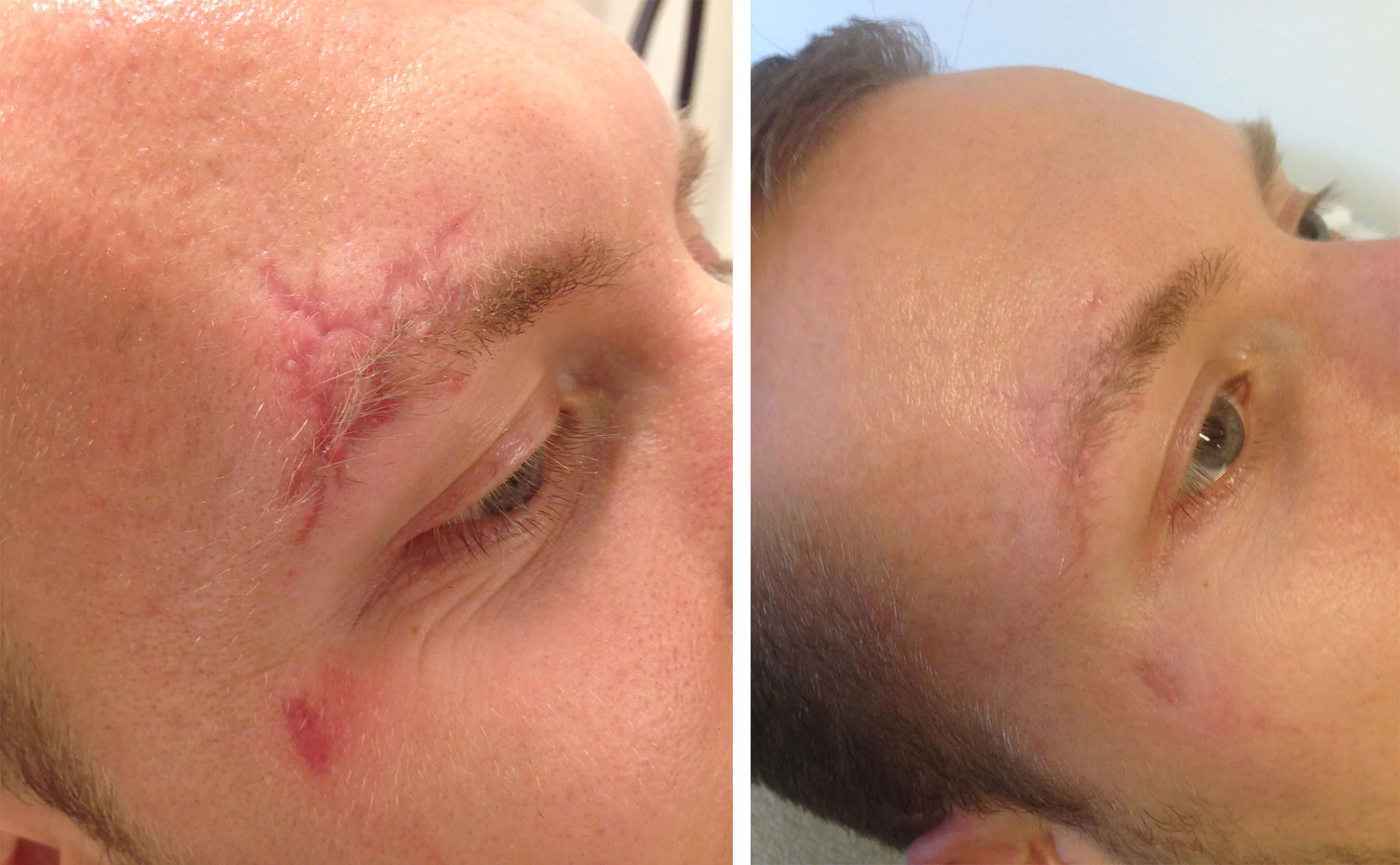 Antes y después de tratar con láser una cicatriz – Clínica Estética Castelblanque