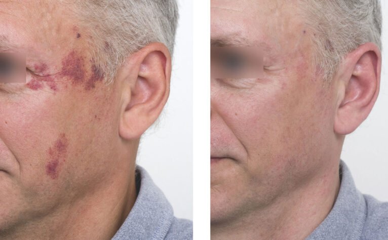 Antes y después del tratamiento con láser de una mancha facial en un hombre - Clínica Estética Castelblanque