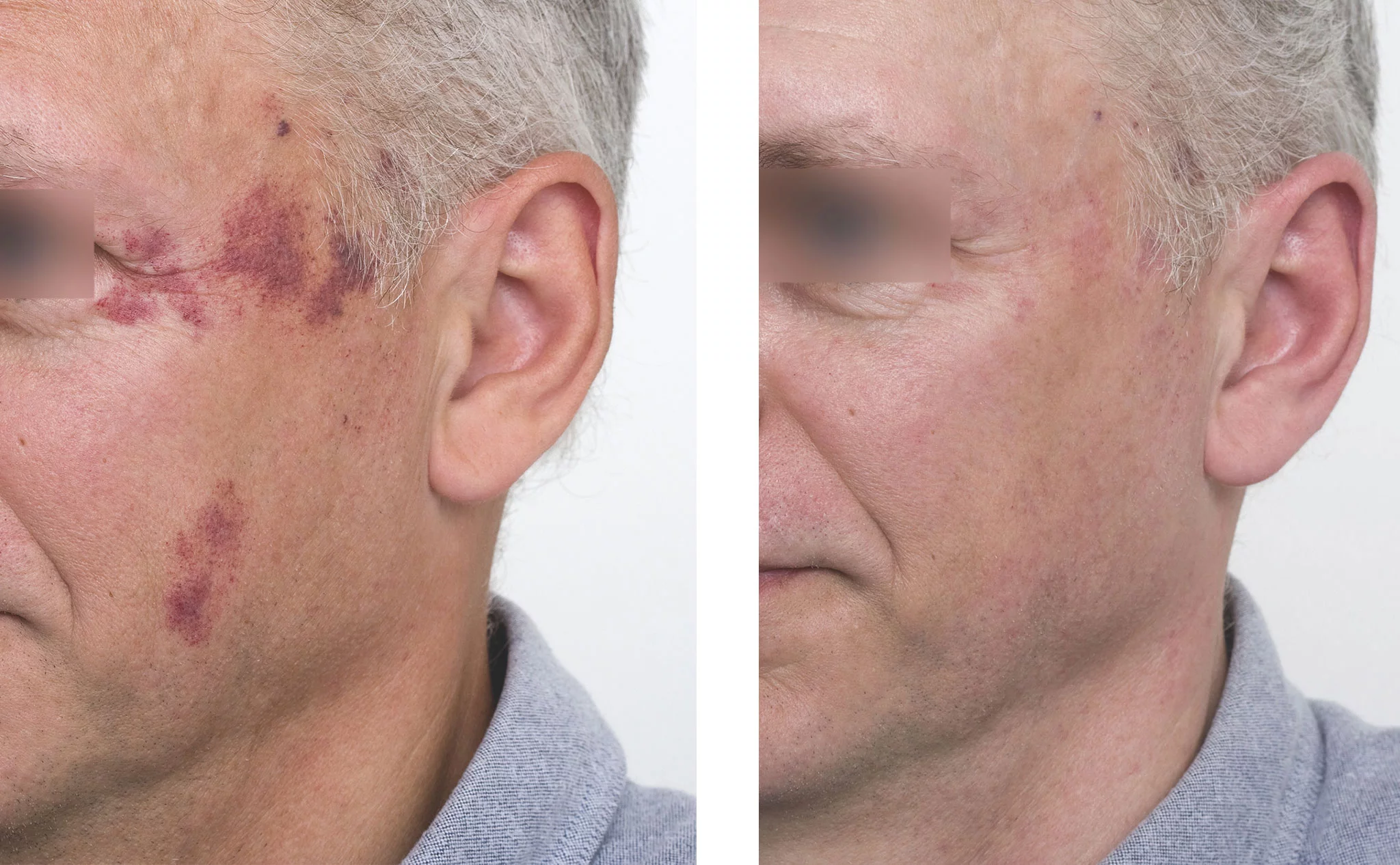 Antes y después del tratamiento con láser de una mancha facial en un hombre – Clínica Estética Castelblanque