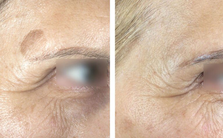 Antes y después del tratamiento con láser de una mancha facial - Clínica Estética Castelblanque