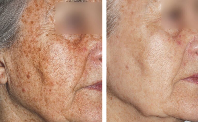 Antes y después del tratamiento con láser para las manchas faciales - Clínica Estética Castelblanque