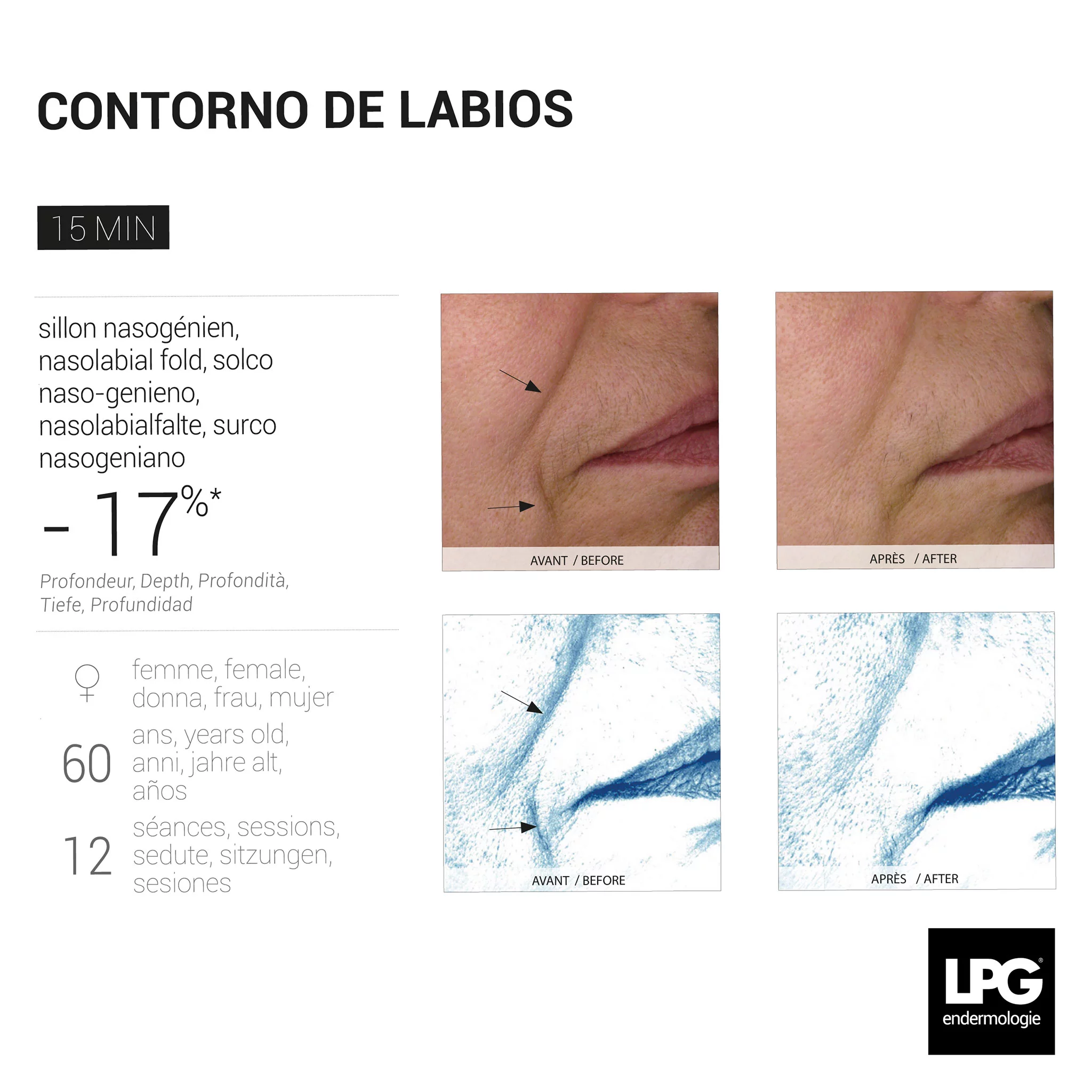 Antes y después de un tratamiento del contorno de labios con LPG Endermologie en Centre Fisiobioestètic