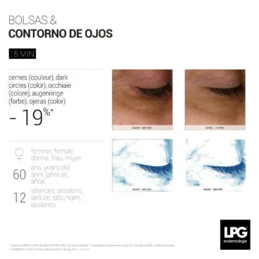 Antes y después de un tratamiento sobre el contorno de ojos con LPG Endermologie en Centre Fisiobioestètic