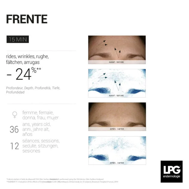 Descubre el placer de LPG Endermologie y saca tu belleza en Centre Fisiobioestètic 6 antes y despues tratamiento frente lpg endermologie centre fisiobioestetic