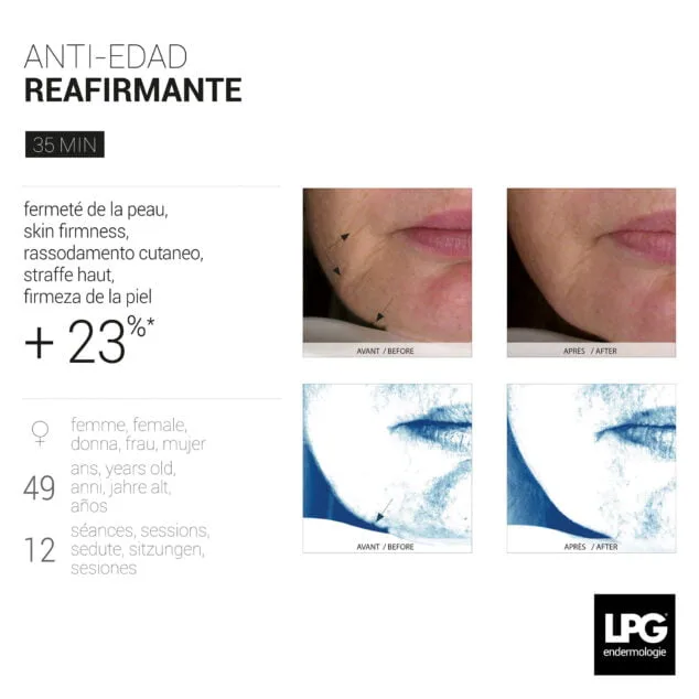 Descubre el placer de LPG Endermologie y saca tu belleza en Centre Fisiobioestètic 5 antes y despues tratamiento reafirmante lpg endermologie centre fisiobioestetic