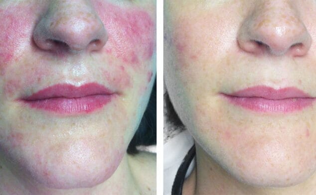 Olvídate de las rojeces con resultados espectaculares en Clínica Estética Castelblanque 1 Imagen: Antes y después de un tratamiento contra las manchas en el rostro - Clínica Estética Castelblanque