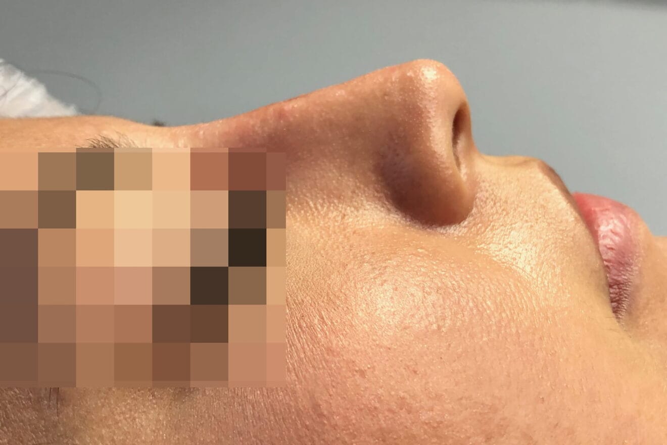 Corrección de nariz sin cirugía en Dénia - Clínica Médica Montgó