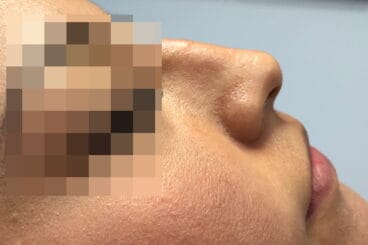 Corrección de nariz (rinomodelación) en Dénia – Clínica Médica Montgó