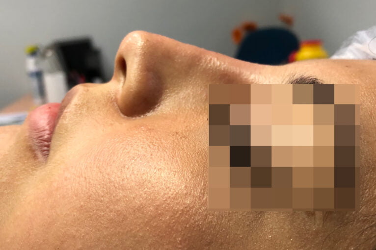 Corrección de nariz sin cirugía (rinomodelación) en Dénia - Clínica Médica Montgó