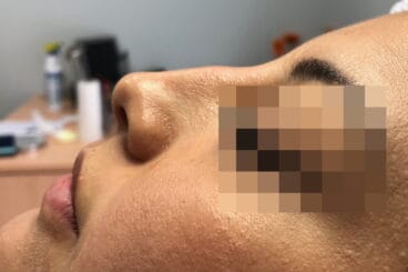 Rinomodelación Dénia – Clínica Médica Montgó