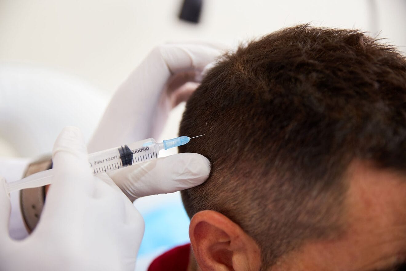 Tratamiento de mesoterapia capilar - Policlínica CUME