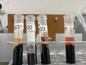 analisis del dimero d en laboratorios gonzalez