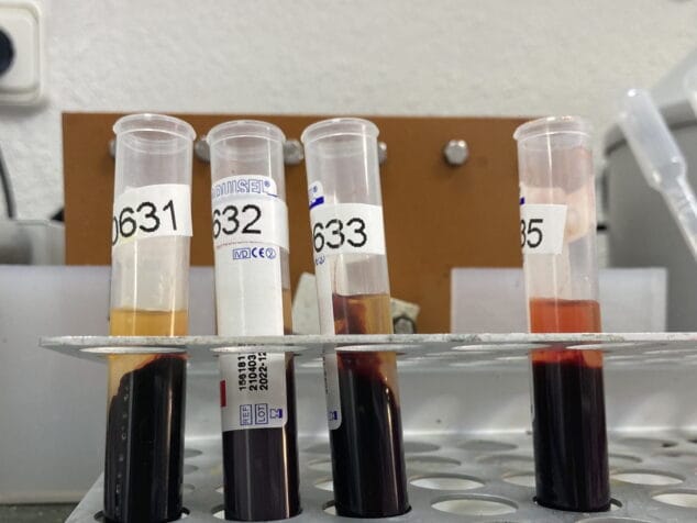 ¿Están relacionados el dímero-D y los episodios trombóticos en pacientes con COVID-19? Te lo explicamos 2 Imagen: Análisis del dímero-D en Laboratorios González