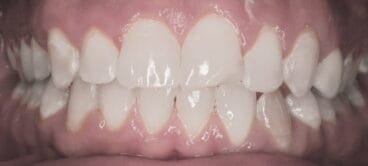 Después del tratamiento de ClearCorrect