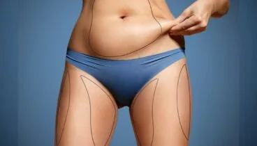 liposuccion dr julio puig