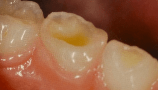 Imatge: Atrició (desgast) dentària fisiològica de les dents temporals