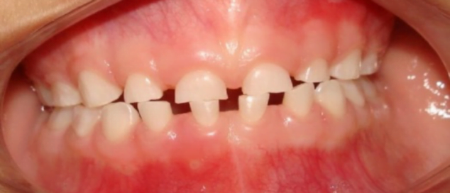 Image: Wear of the incisal edge of the primary incisors due to bruxism