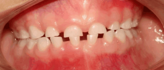 Imatge: Desgast de la vora incisal dels incisius temporals per bruxisme
