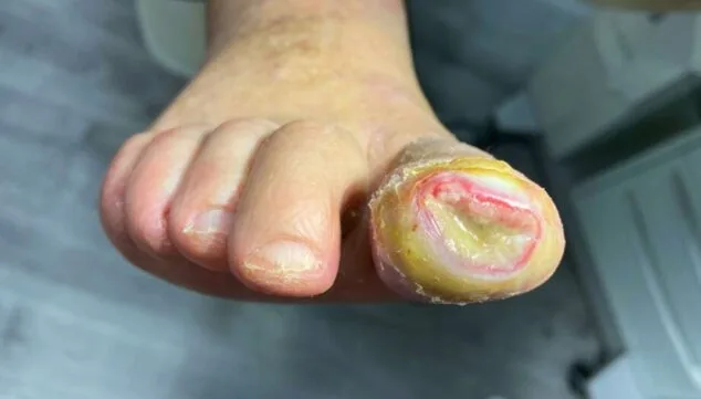 Pie diabético: descubre la importancia de su cuidado con esta clínica podológica 3 consecuencias de la mala regulacion del azucar