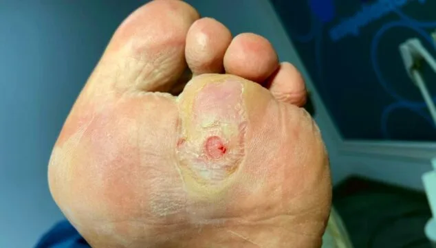 Pie diabético: descubre la importancia de su cuidado con esta clínica podológica 4 el pie diabetico requiere tratamiento periodico y a tiempo