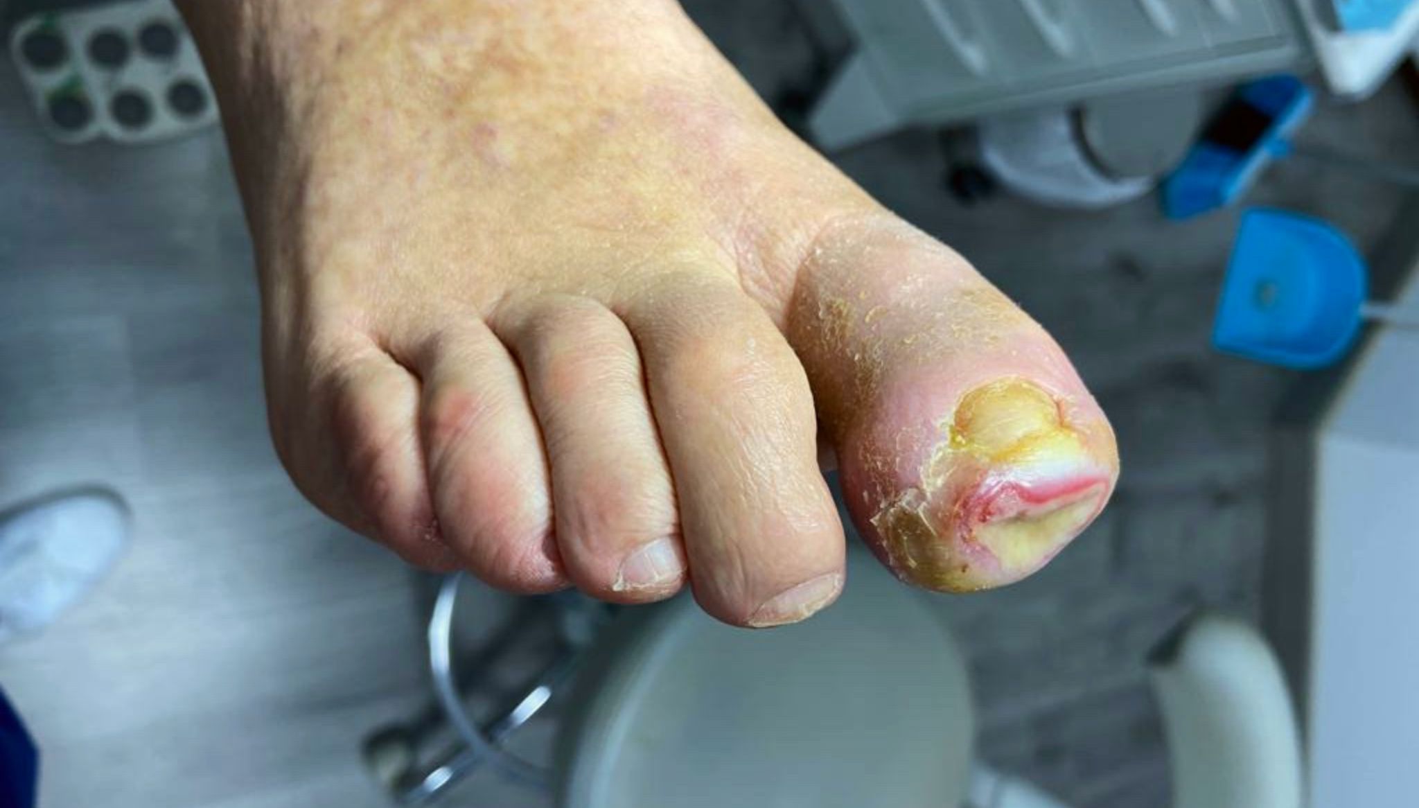 Úlceras del pie diabético en Clínica Podológica Estévez