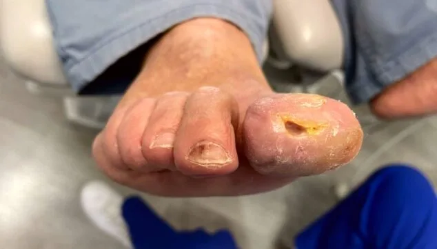 Pie diabético: descubre la importancia de su cuidado con esta clínica podológica 5 ulceras en pie diabetico que pueden derivar en amputacioes
