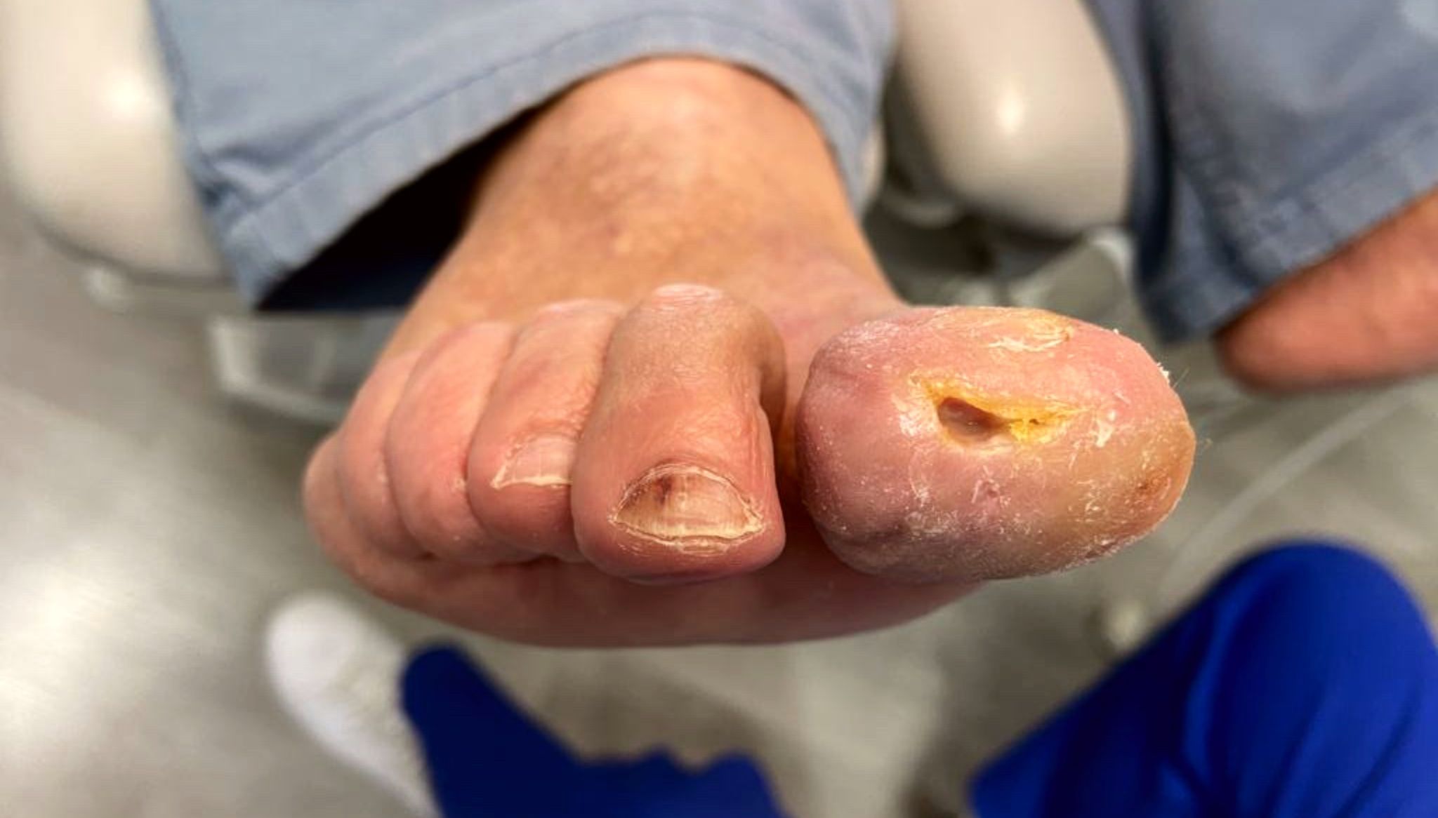 Úlceras en pie diabético que pueden derivar en amputacioes