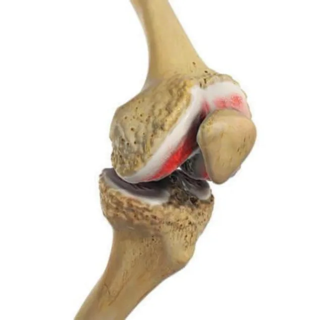 Prótesis de rodilla: qué es, cuánto dura, recuperación y resultados 1 articulacion dancc83ada debido al desgaste