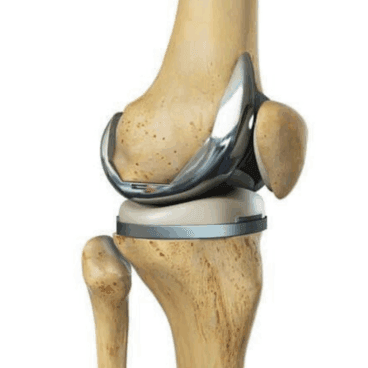 Prótesis de rodilla – Clínica Dr Ballester