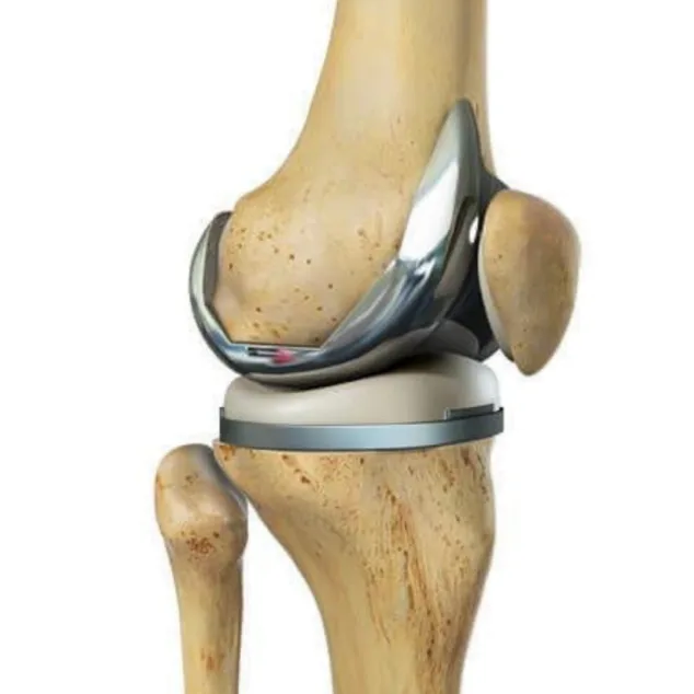 Prótesis de rodilla: qué es, cuánto dura, recuperación y resultados 2 protesis de rodilla clinica dr ballester