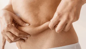 elimina la grasa localizada con este tratamiento clinica dra flores de apodaca