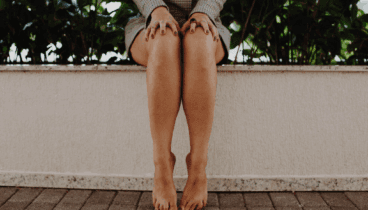 Piernas tras la cirugía con Dr. Julio Puig