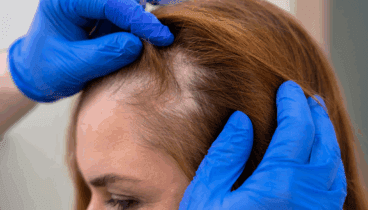 Previene la alopecia con los tratamientos de Policlínica CUME