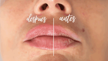 Descubre el ante y después con este tratamiento
