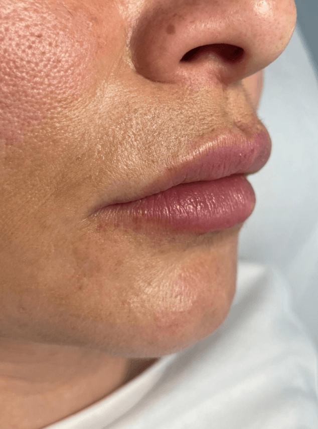 descubre el antes y despues de este tramiento