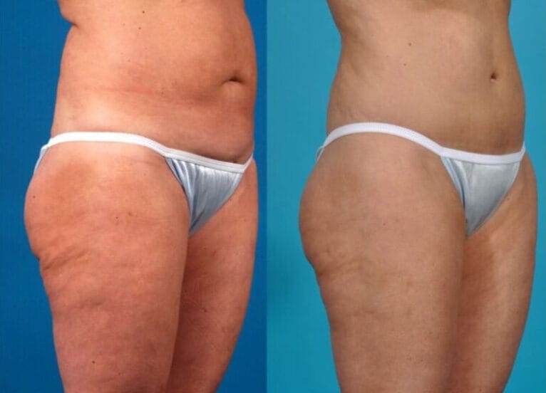 Antes y después del tratamiento Morpheus 8