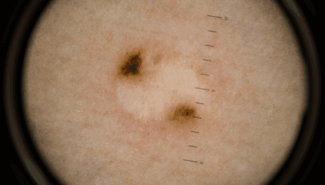 Imagen: Detección de lesiones cutáneas benignas y malignas - HLA San Carlos