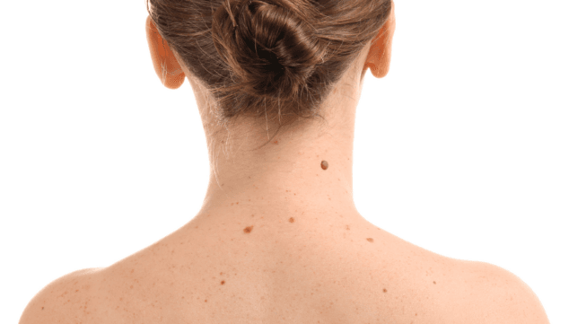 Imagen: Diagnóstico de las lesiones cutáneas en HLA San Carlos