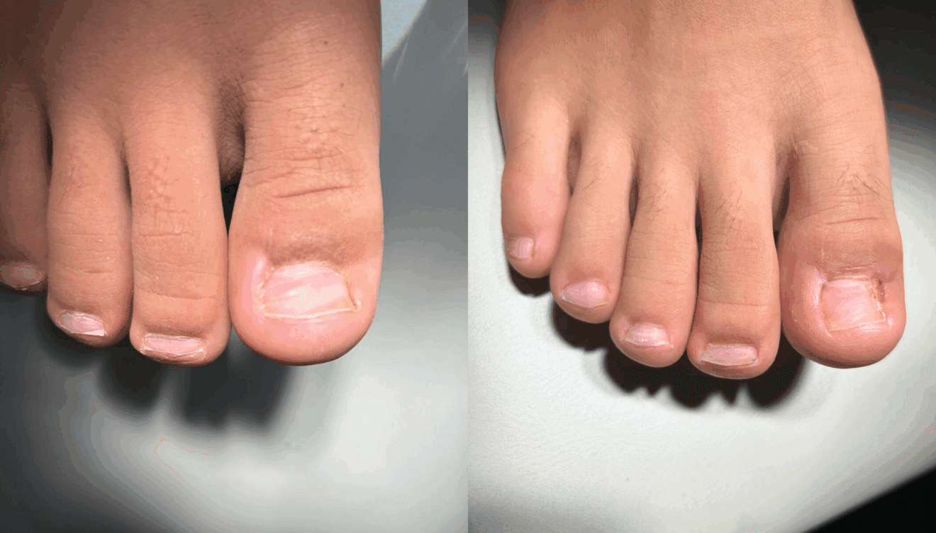 Clínica Podológica Estévez dispone de la solución definitiva para las uñas encarnadas