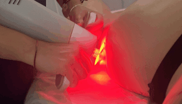 Con tecnología avanzada, el láser de diodo elimina el vello de manera segura y eficaz
