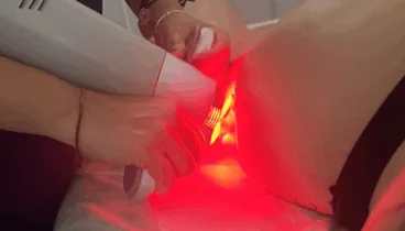 Con tecnología avanzada, el láser de diodo elimina el vello de manera segura y eficaz