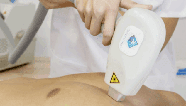 prepara't per a l'estiu amb una pell suau i lliure de borrissol gràcies a la depilació amb làser de díode