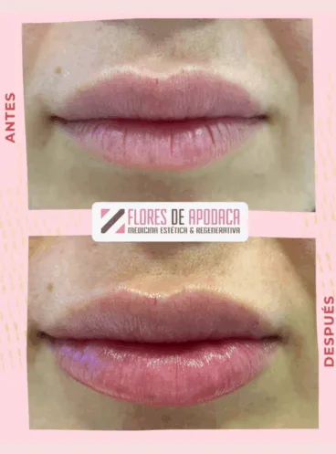 Aporta volumen sutil y suavidad a tus labios con resultados personalizados