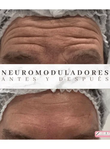Los neuromoduladores  relajan la musculatura de la frente, el entrecejo y las llamadas” patas de gallo”