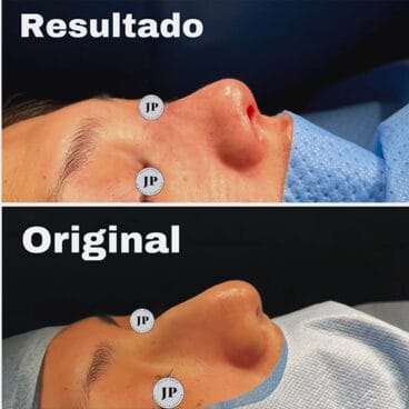 El antes y después de la rinplastia ultrasónica