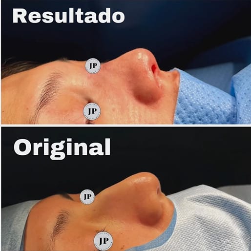 Imagen: El antes y después de la rinplastia ultrasónica